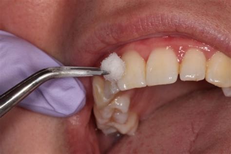 scratch test dental|tooth loss test methods.